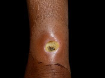 Beitragsbild 2 für den Beitrag: Diabetische Fußinfektion